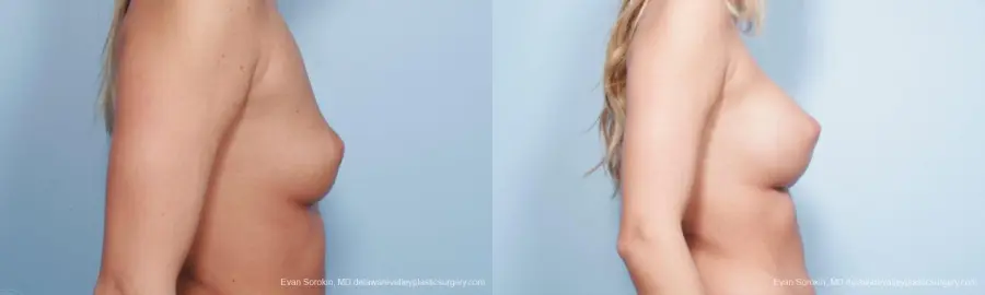 Philadelphia Breast Augmentation 9177 - Before and After 5