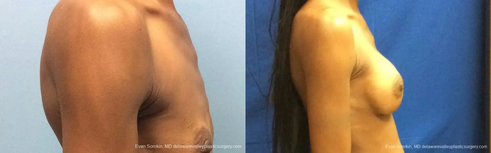 Philadelphia Breast Augmentation 13072 - Before and After 3