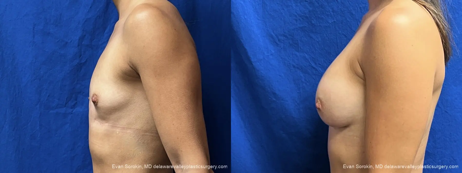Breast Augmentation: Patient 309 - Before and After 4