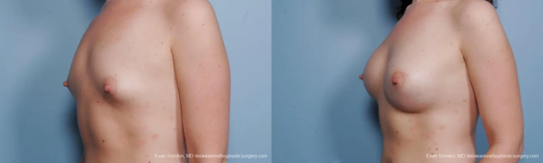 Philadelphia Breast Augmentation 9176 - Before and After 4