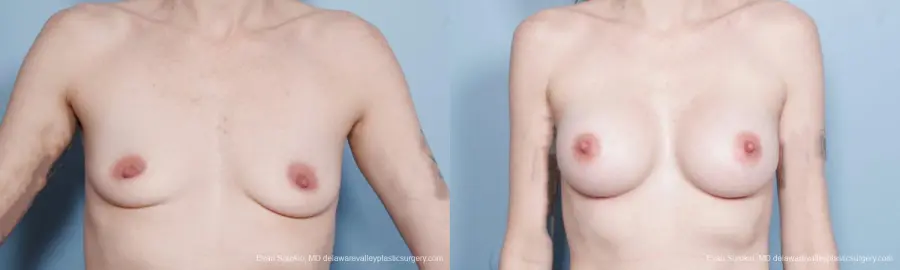 Philadelphia Breast Augmentation 8649 - Before and After 1