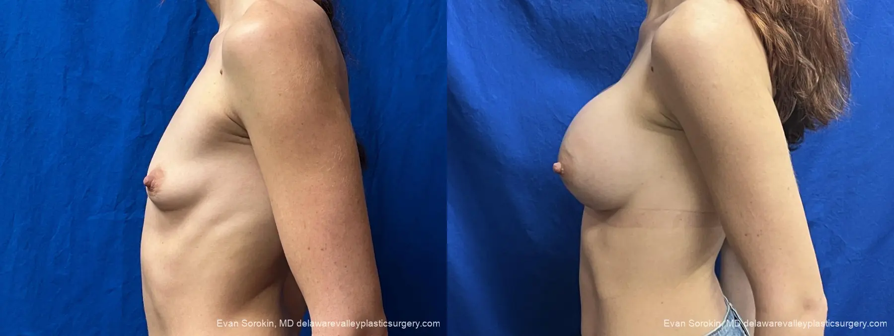 Breast Augmentation: Patient 307 - Before and After 5
