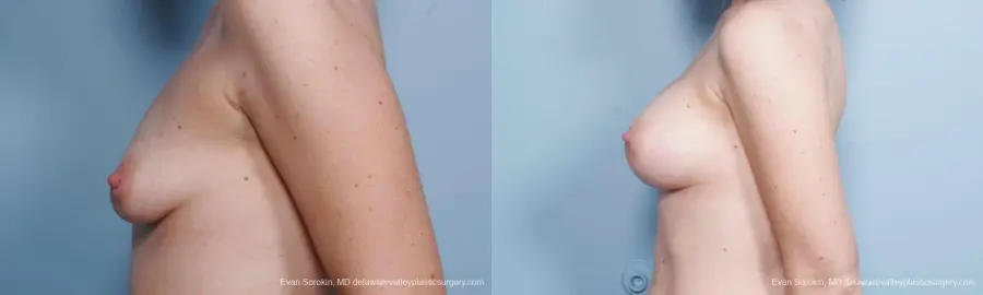 Philadelphia Breast Augmentation 9302 - Before and After 5