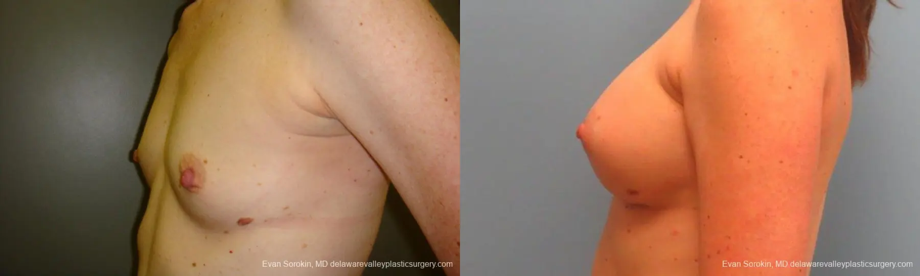 Philadelphia Breast Augmentation 9180 - Before and After 5