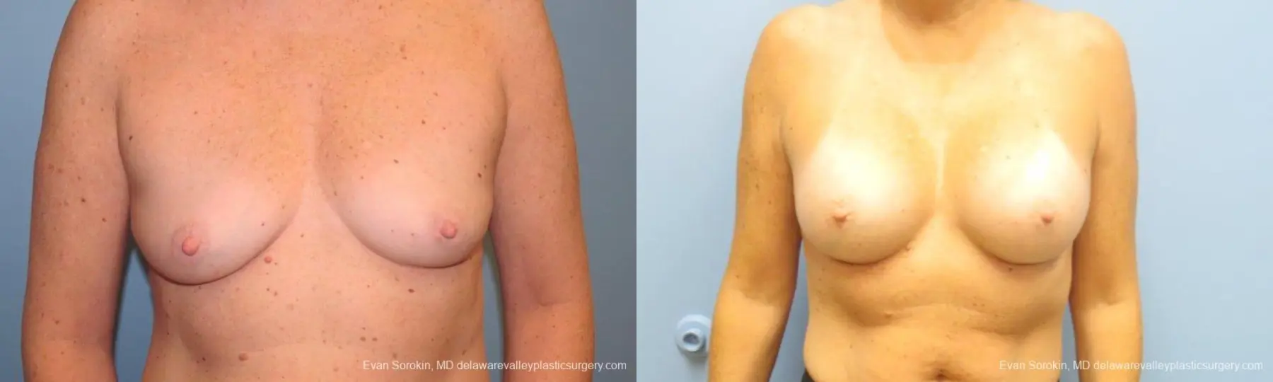 Philadelphia Breast Augmentation 9549 - Before and After 1