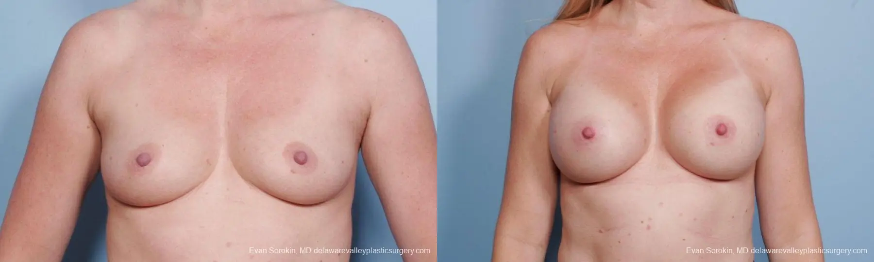 Philadelphia Breast Augmentation 9178 - Before and After 1