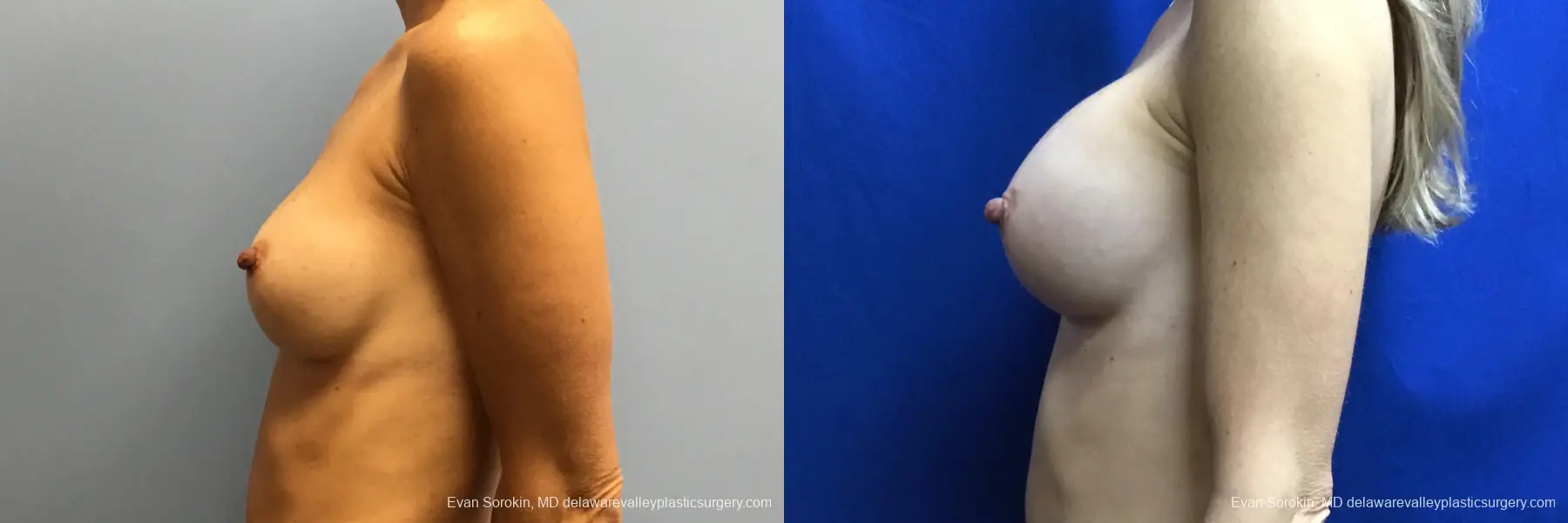 Breast Augmentation: Patient 227 - Before and After 5