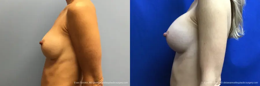 Breast Augmentation: Patient 223 - Before and After 5