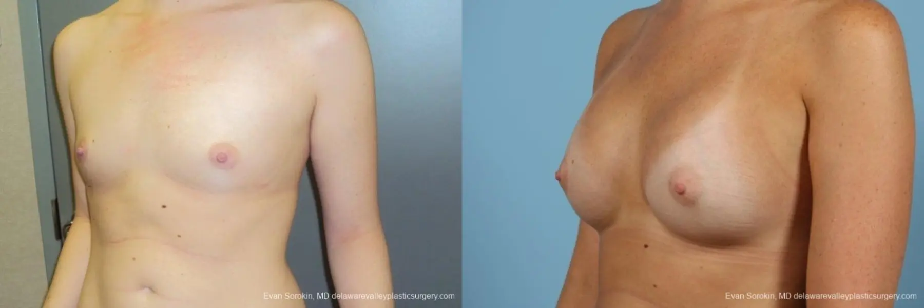 Philadelphia Breast Augmentation 8669 - Before and After 3