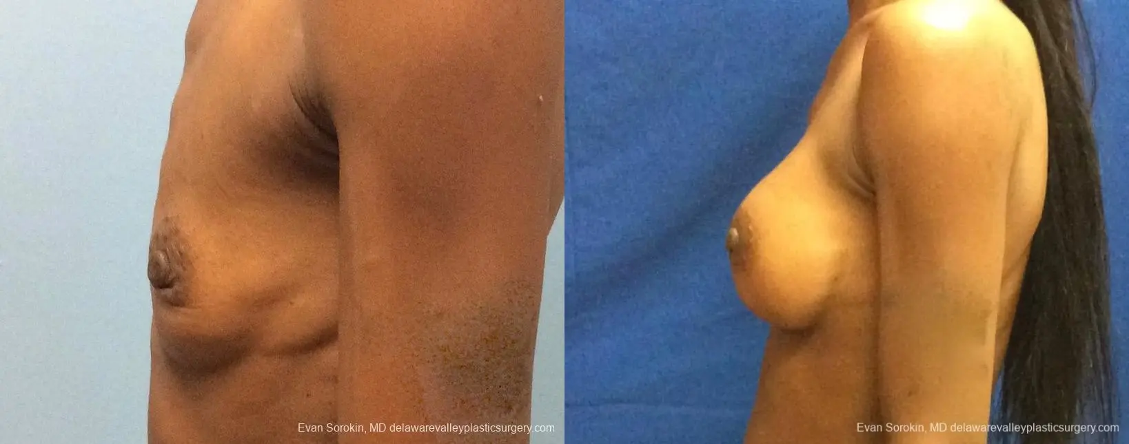 Philadelphia Breast Augmentation 13072 - Before and After 5