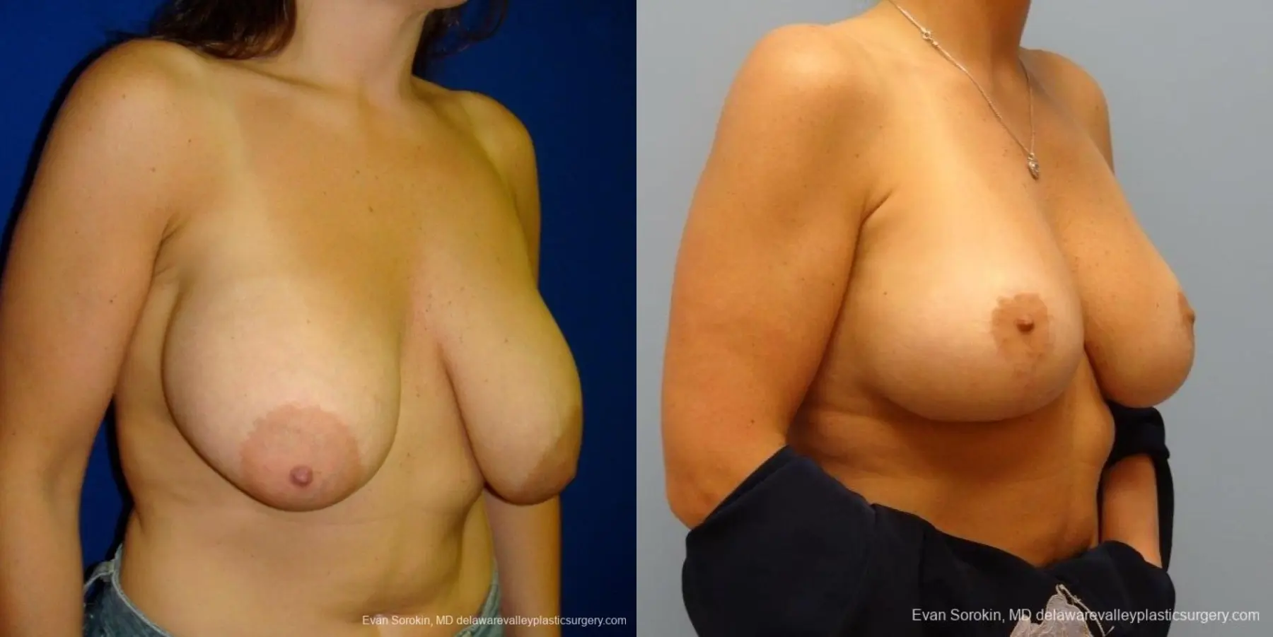 Philadelphia Breast Augmentation 8695 - Before and After 2