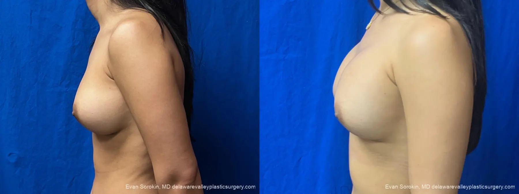 Breast Augmentation: Patient 322 - Before and After 4
