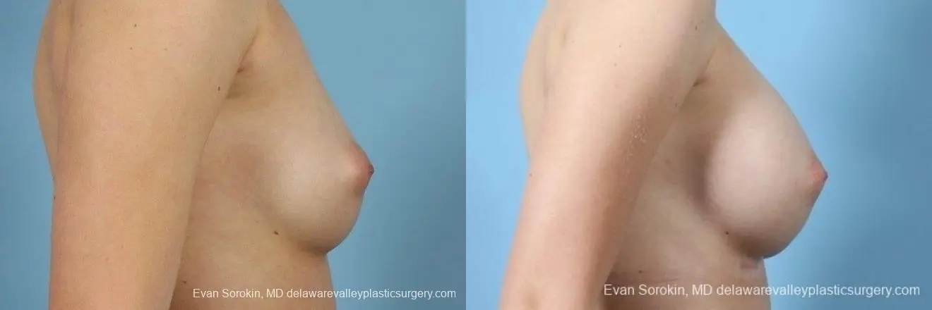 Philadelphia Breast Augmentation 8766 - Before and After 4
