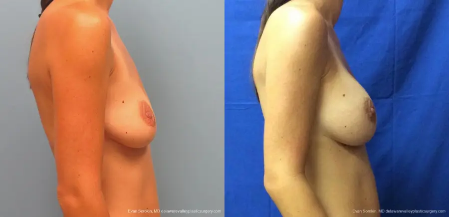 Philadelphia Breast Augmentation 13067 - Before and After 3