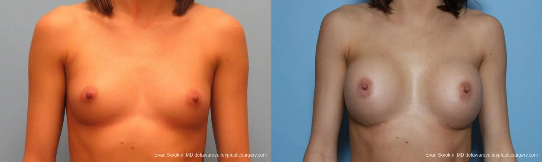 Philadelphia Breast Augmentation 9421 - Before and After 1
