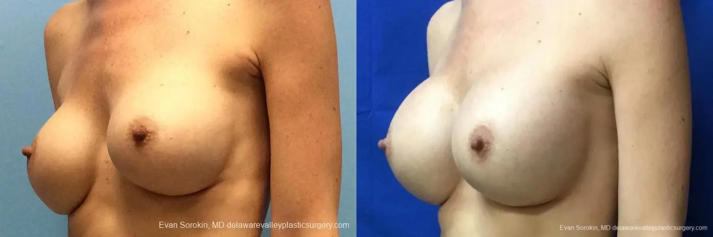 Philadelphia Breast Augmentation 10815 - Before and After 4