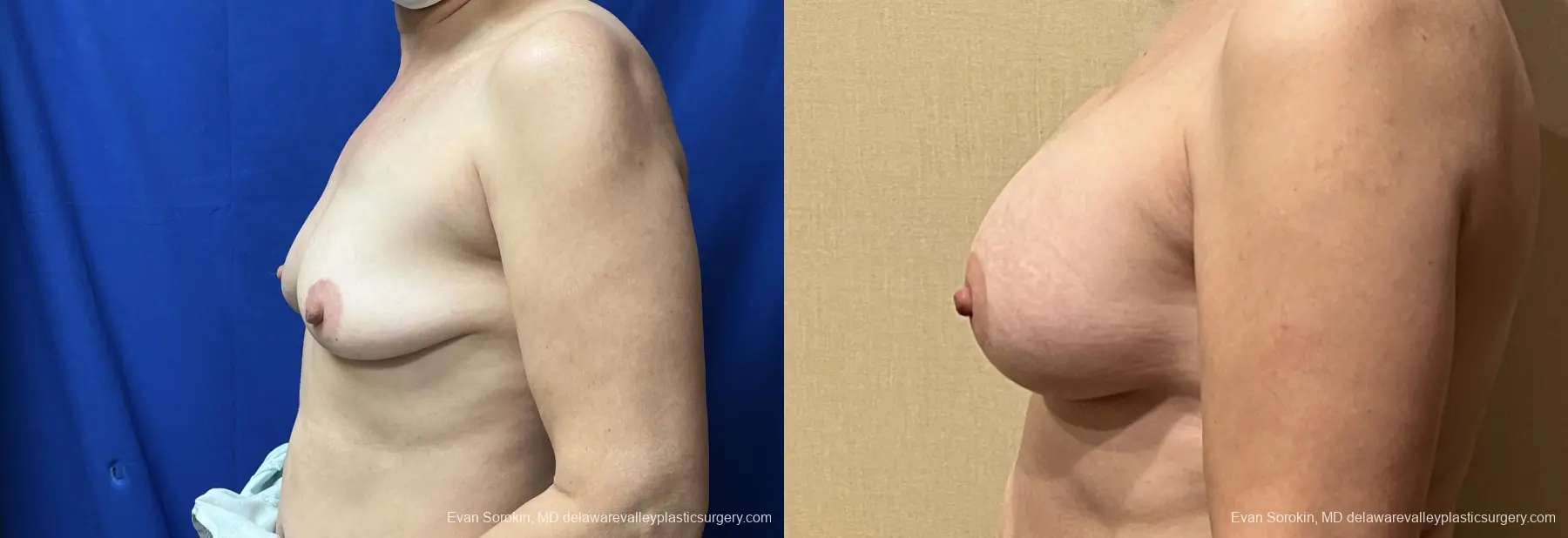 Breast Augmentation: Patient 255 - Before and After 5
