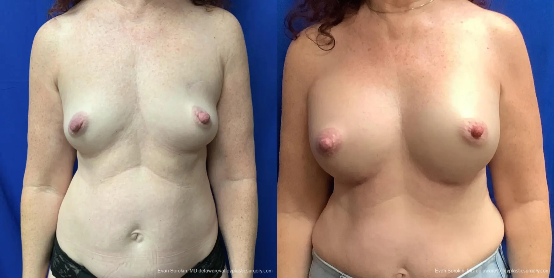 Breast Augmentation: Patient 176 - Before and After 1