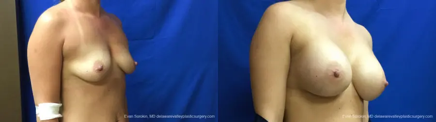 Philadelphia Breast Augmentation 13173 - Before and After 2