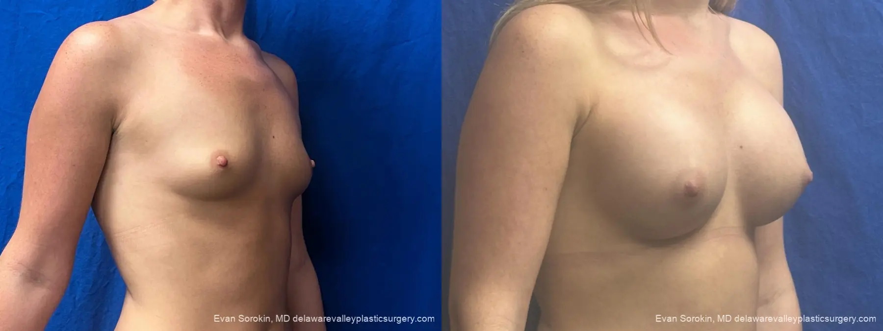 Breast Augmentation: Patient 328 - Before and After 2