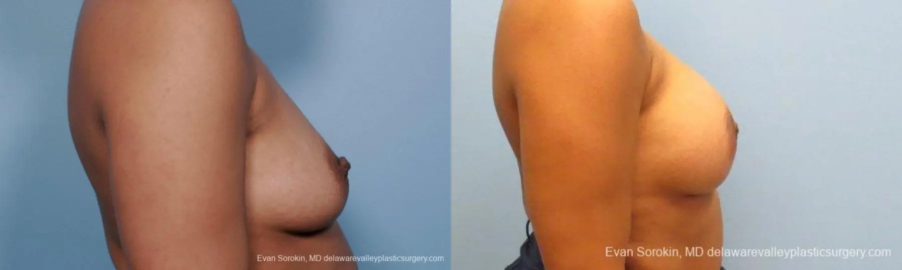 Philadelphia Breast Augmentation 9387 - Before and After 3