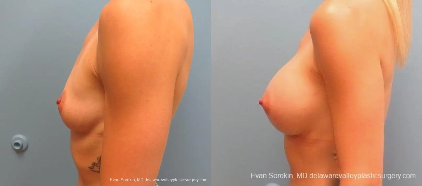 Philadelphia Breast Augmentation 8823 - Before and After 5