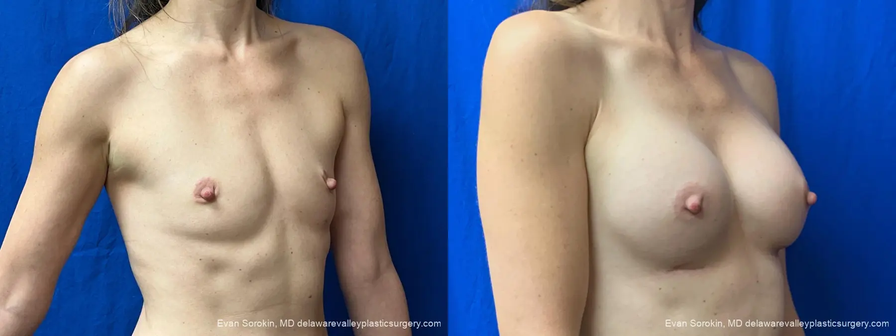 Breast Augmentation: Patient 325 - Before and After 2