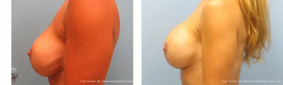 Breast Augmentation Revision: Patient 10 - Before and After 3