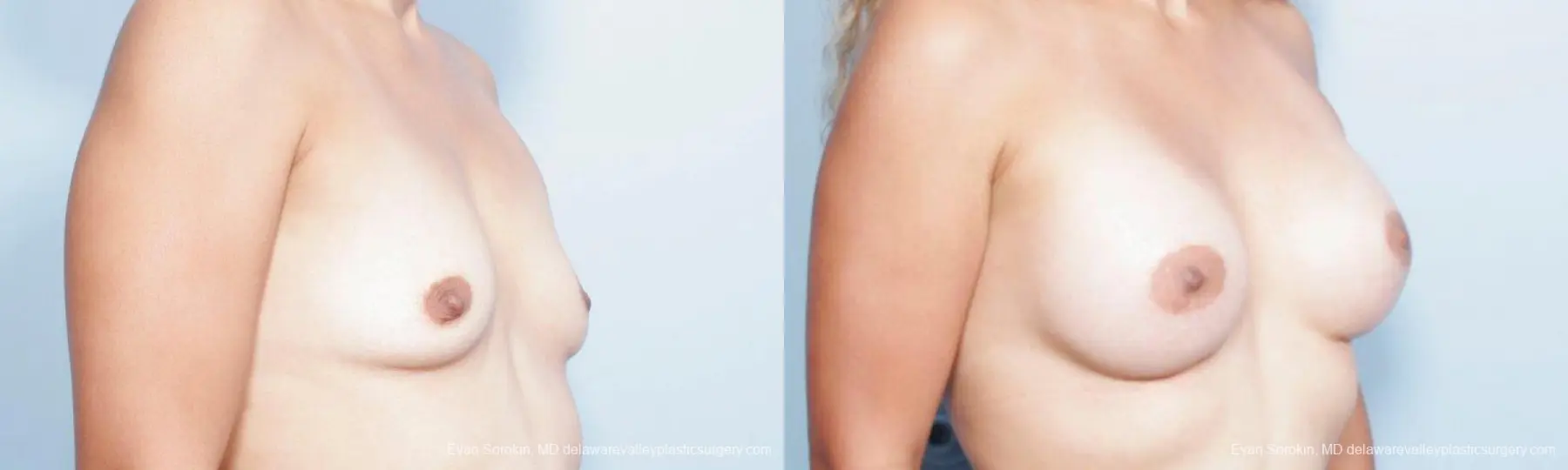 Philadelphia Breast Augmentation 9347 - Before and After 2