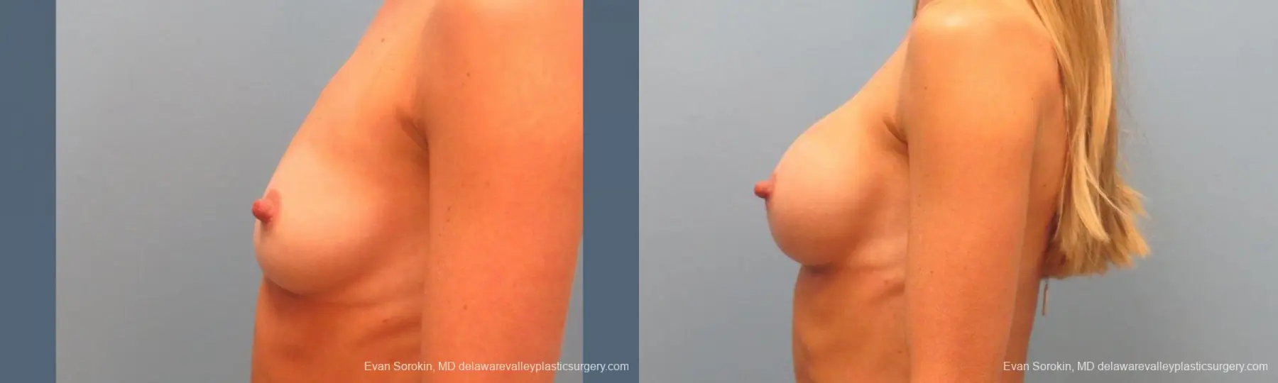 Philadelphia Breast Augmentation 9397 - Before and After 5