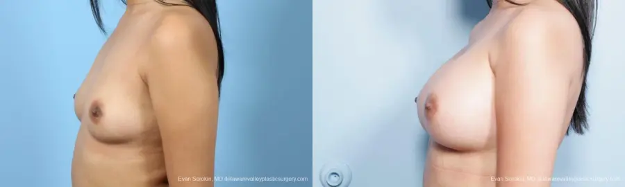 Philadelphia Breast Augmentation 9298 - Before and After 5