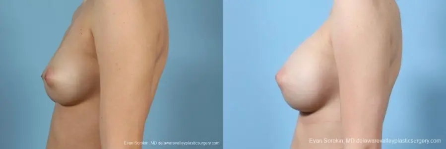 Philadelphia Breast Augmentation 8766 - Before and After 5