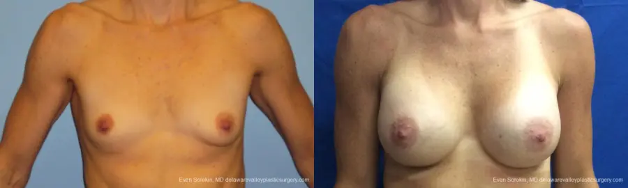 Philadelphia Breast Augmentation 10248 - Before and After 1