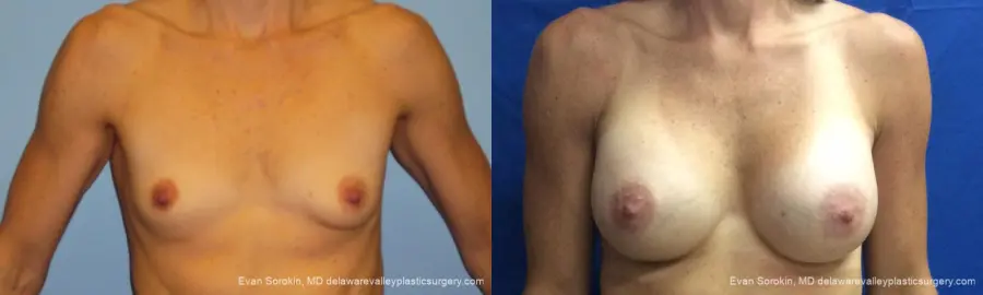 Philadelphia Breast Augmentation 10248 - Before and After 1