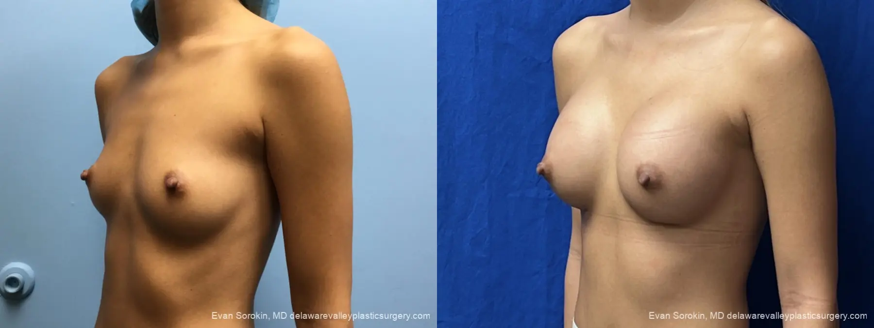 Breast Augmentation: Patient 327 - Before and After 4