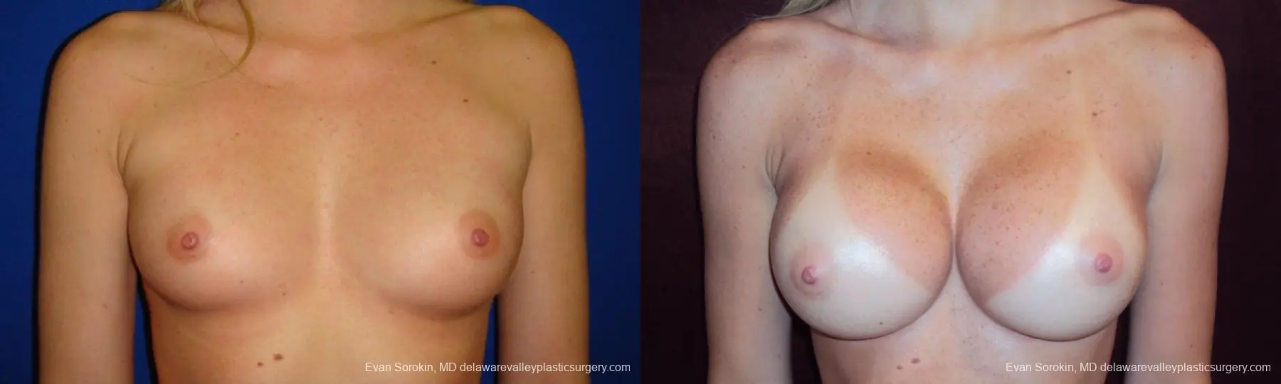 Philadelphia Breast Augmentation 9293 - Before and After 1