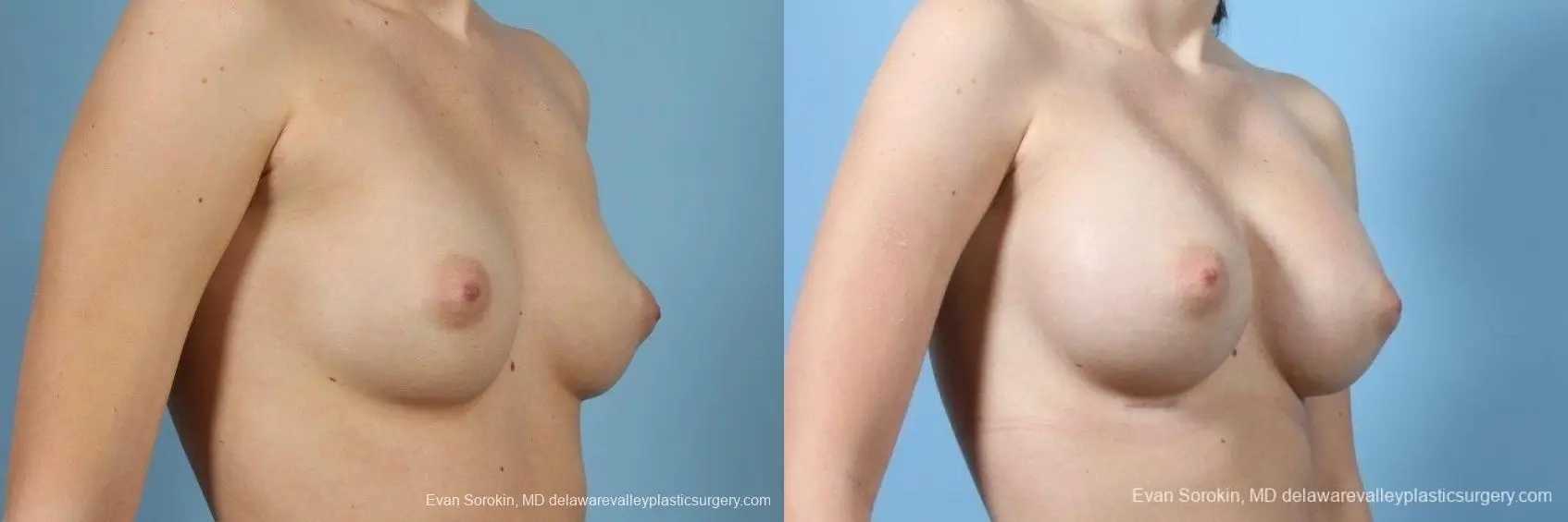 Philadelphia Breast Augmentation 8766 - Before and After 2