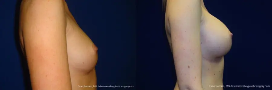 Philadelphia Breast Augmentation 8670 - Before and After 4