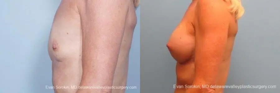 Philadelphia Breast Augmentation 8770 - Before and After 5