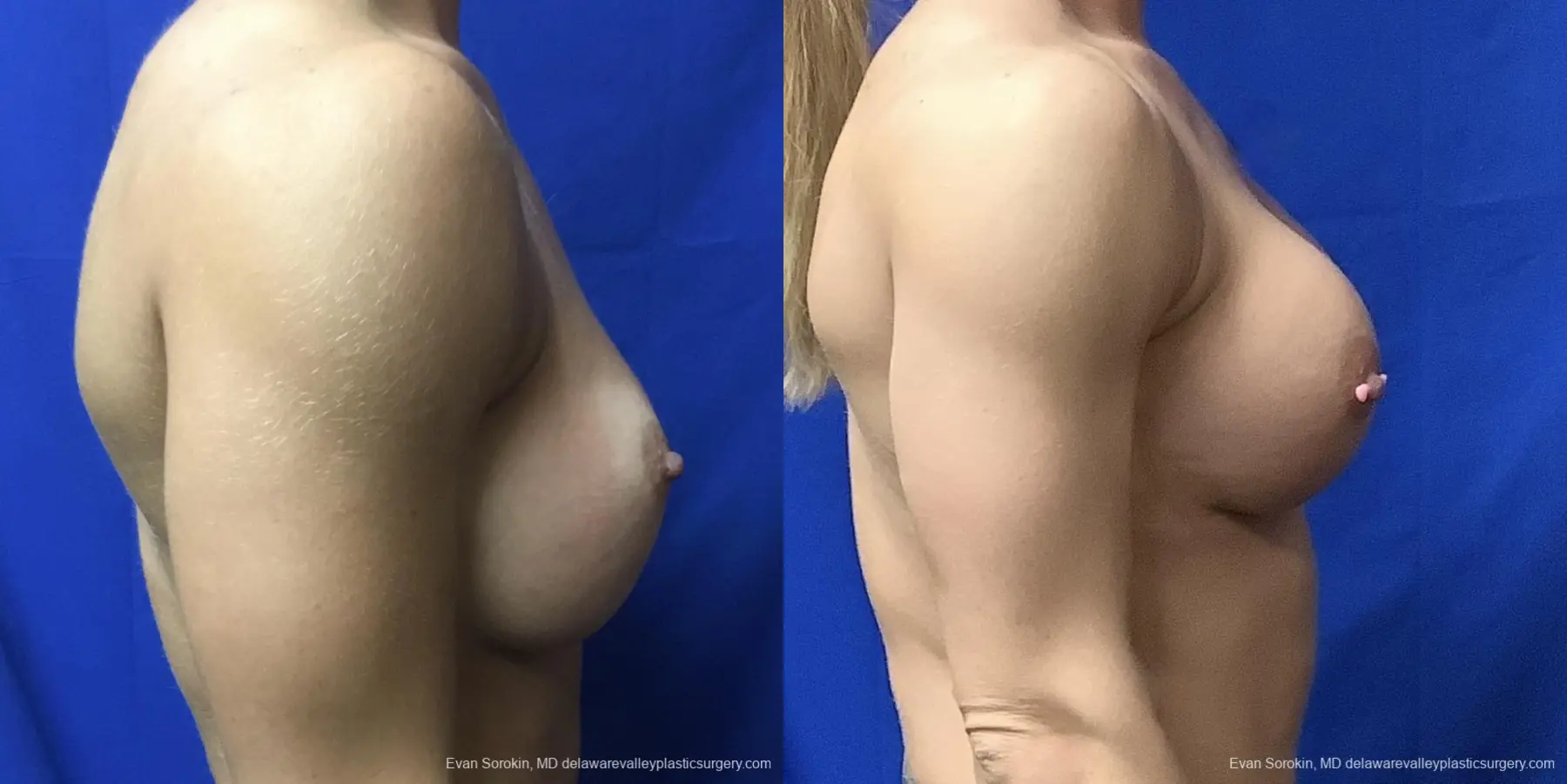 Breast Augmentation Revision: Patient 29 - Before and After 3