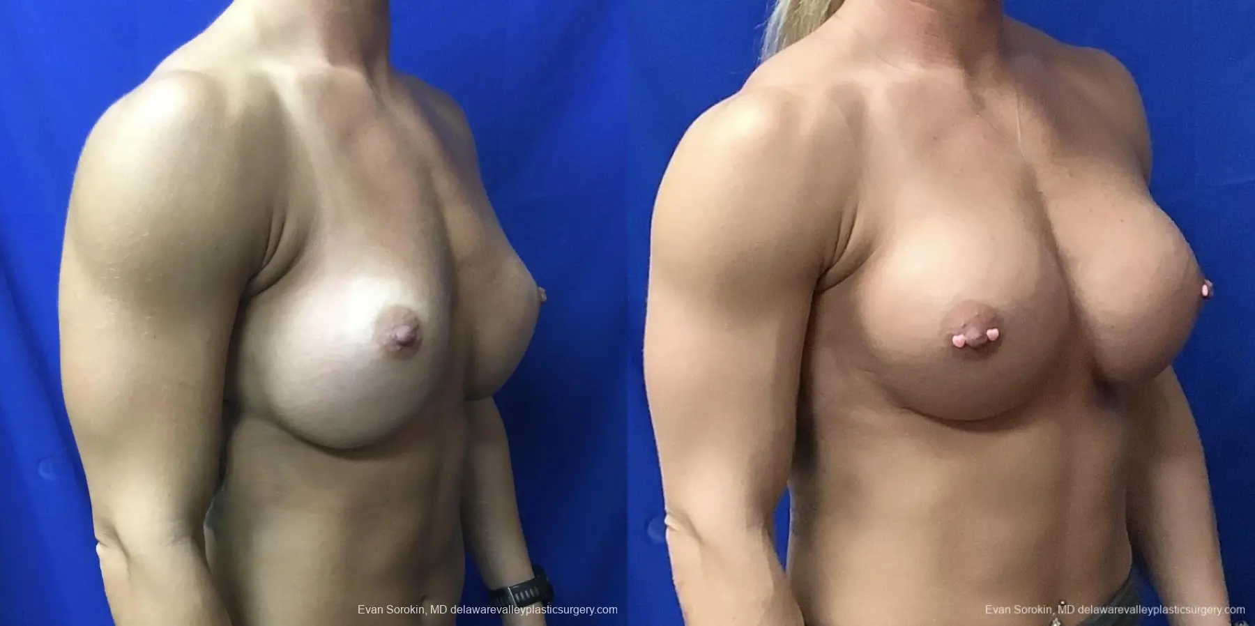 Breast Augmentation Revision: Patient 29 - Before and After 2