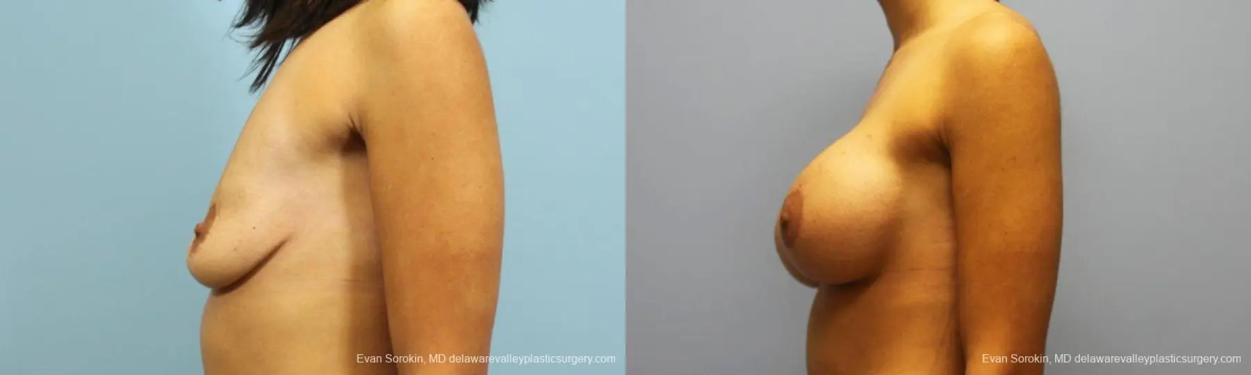Philadelphia Breast Augmentation 9205 - Before and After 5