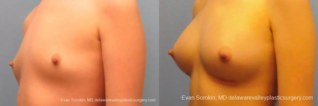 Philadelphia Breast Augmentation 10113 - Before and After 4