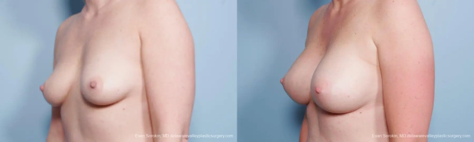 Philadelphia Breast Augmentation 8658 - Before and After 4