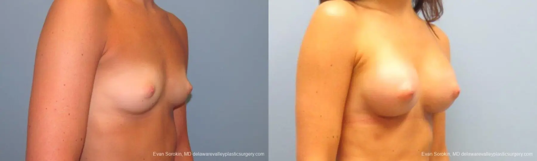 Philadelphia Breast Augmentation 9621 - Before and After 2