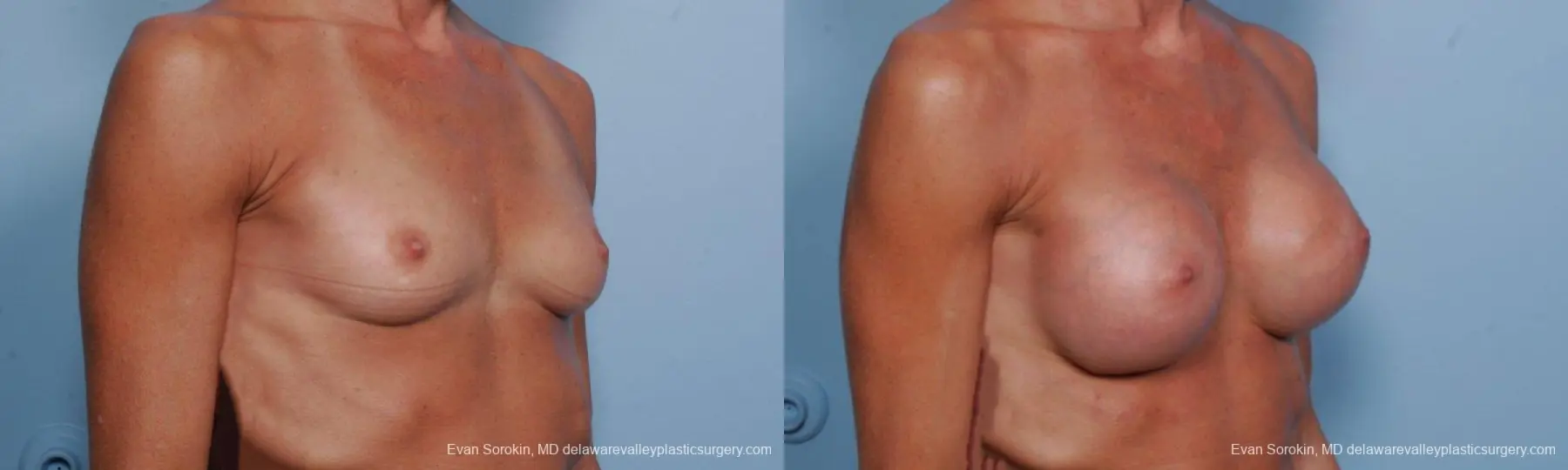 Philadelphia Breast Augmentation 8656 - Before and After 2