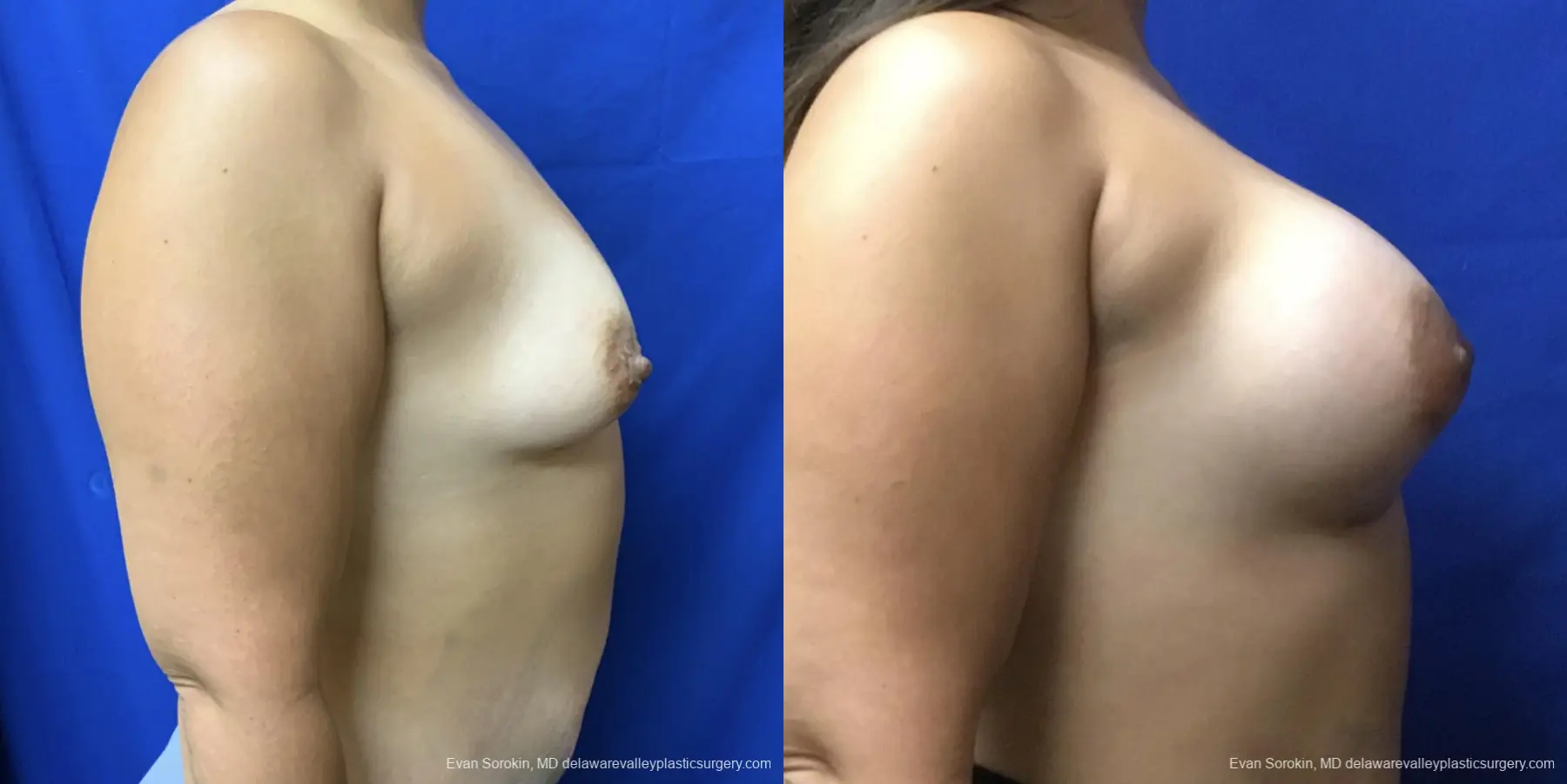 Breast Augmentation: Patient 208 - Before and After 3