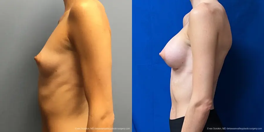 Breast Augmentation: Patient 194 - Before and After 5