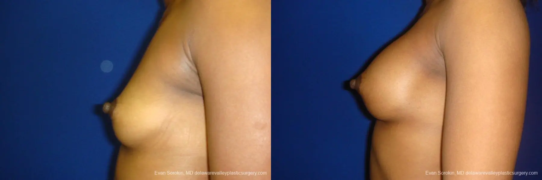 Philadelphia Breast Augmentation 8665 - Before and After 5