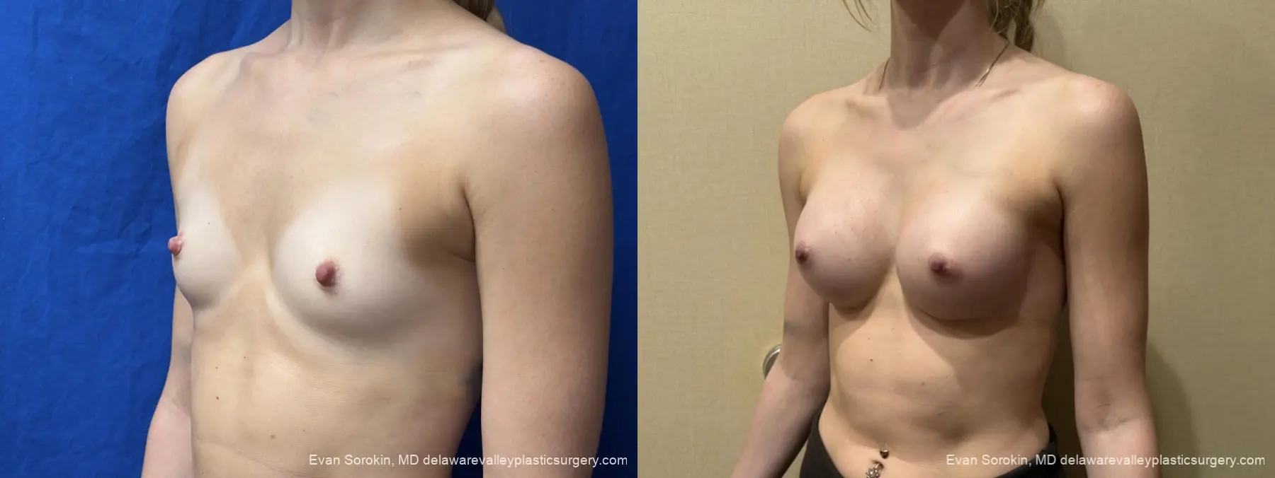 Breast Augmentation: Patient 267 - Before and After 4
